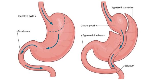 Roux- Y-Gastric-bypass