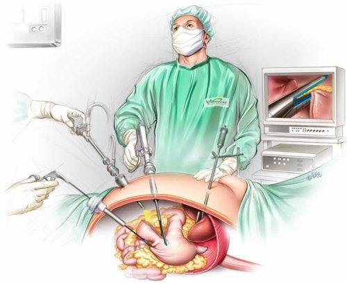 coelioscopie-Laparoscopic-sleeve-gastrectomy